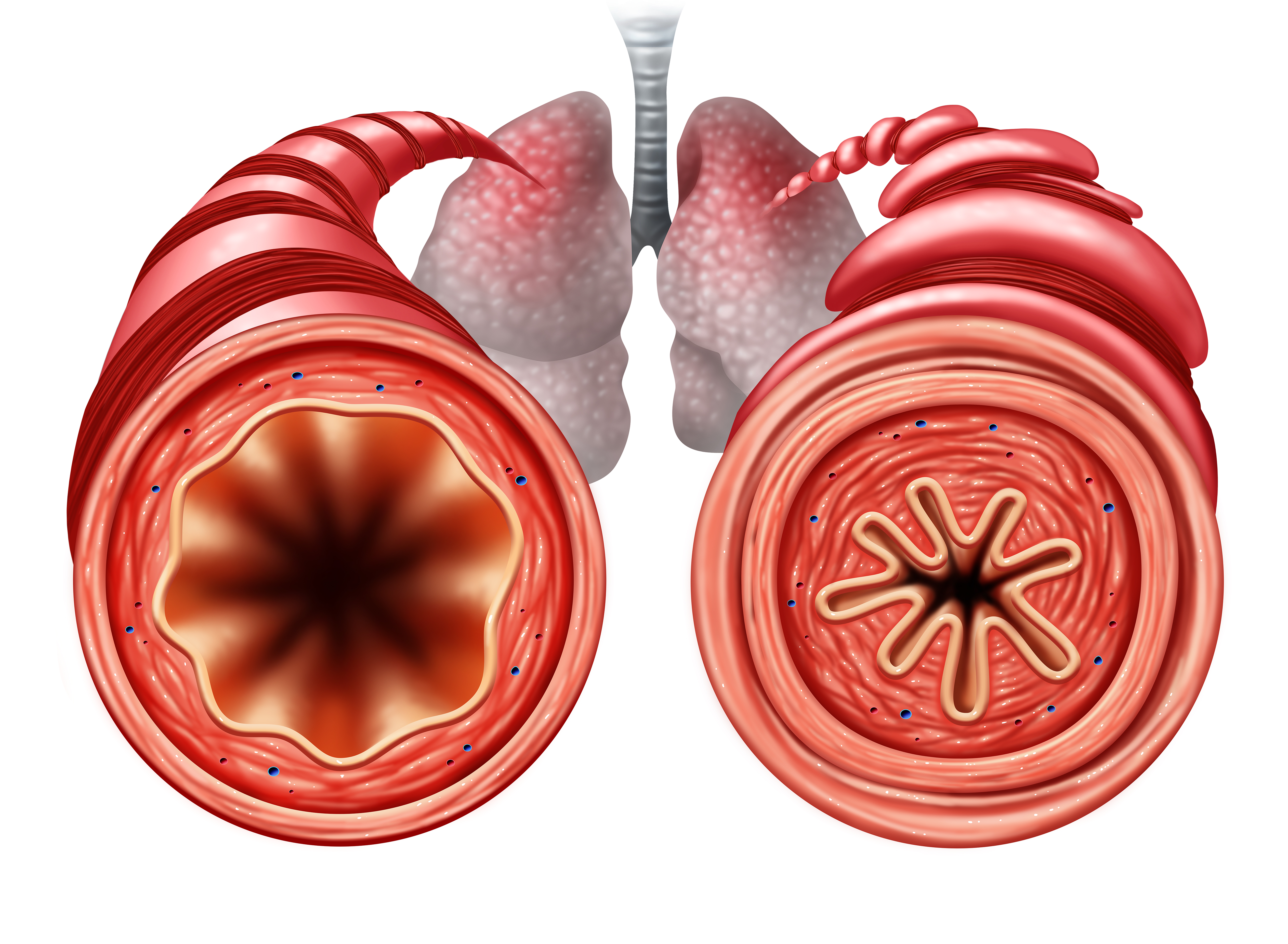 中重度未控制哮喘急性加重史对dupilumab临床疗效的影响