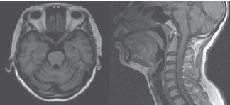 Mov Disord：脊髓小脑共济失调3型严重程度与生活方式有关