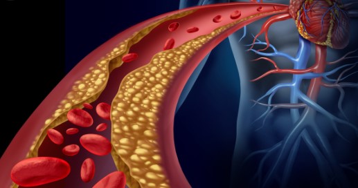 Lancet：家族性高胆固醇血症注意了——胆固醇达标可以明显降低心血管危险！