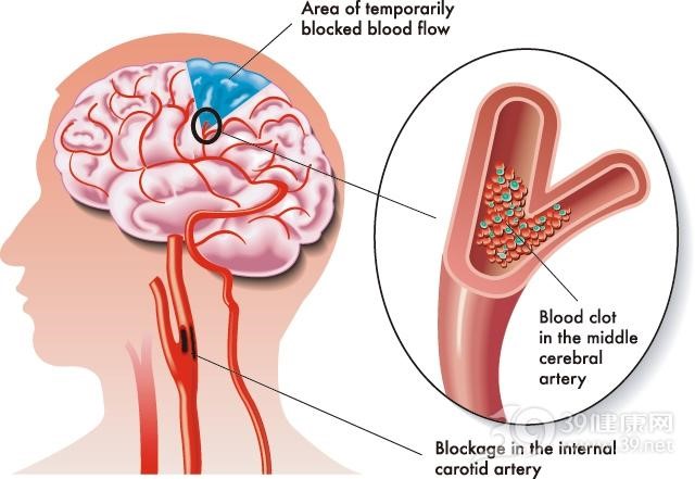 JAMA子刊：小卒中合并大血管闭塞患者单纯静脉溶栓治疗的神经系统结局预测