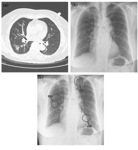 European Radiology：人工智能，使胸片上肺部4类结节无处遁形！