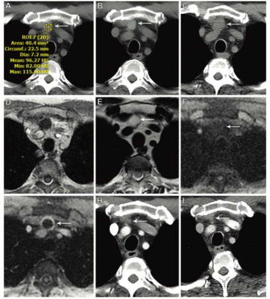 Radiology：单房<font color="red">胸腺</font>囊肿的纵向CT和MRI特征