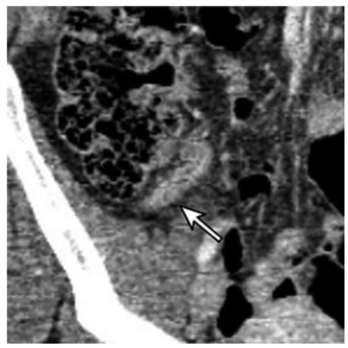 Radiology：低阑尾炎风险患者可以不进行CT扫描吗？不要捡了芝麻丢了西瓜！