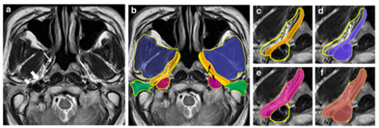 European Radiology：鼻咽癌<font color="red">MRI</font>咽旁亚间隙受累的预后价值