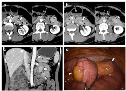 European Radiology：CT小肠造影对小(< 4.5 cm)上皮下肿瘤和异位胰腺的鉴别