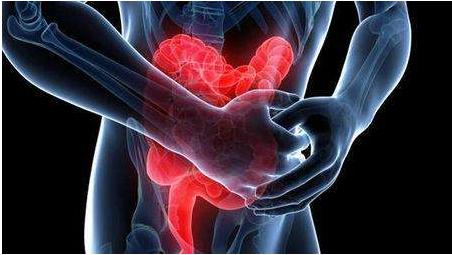 Clin Gastroenterology H: 健康的生活方式与炎症性肠病患者的死亡率降低相关