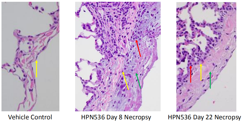 Clin Cancer Res：三特异性T细胞激活蛋白HPN536在表达<font color="red">间</font><font color="red">皮</font><font color="red">素</font>的恶性肿瘤中的活性