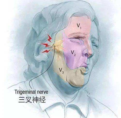 Neuromodulation：植入式周围<font color="red">神经</font>刺激治疗三叉<font color="red">神经</font><font color="red">源</font><font color="red">性</font><font color="red">疼痛</font>：系统回顾和荟萃分析