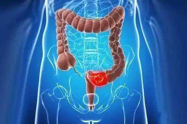 Gastroenterology：不同年龄<font color="red">段</font>体重指数与早发性结直肠癌的相关性