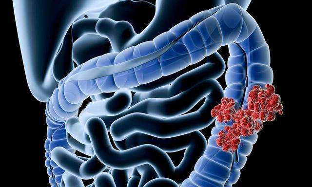 Gastroenterology：高脂肪饮食通过调节肠道微生物群和代谢物促进结直肠肿瘤发生