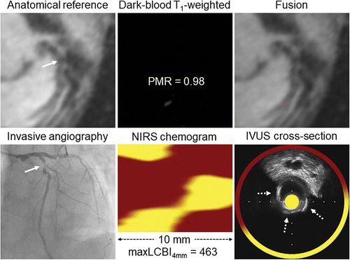 Radiology：稳定型冠脉疾病T1MRI高信号是斑块内出血而非脂质成分