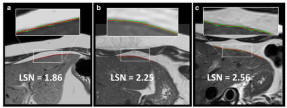European Radiology：平扫MRI的这一表现，可实现NAFLD患者<font color="red">肝</font>纤维化的无创评估！