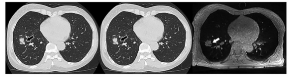 Radiology：肺部MRI对肺结节判析的价值