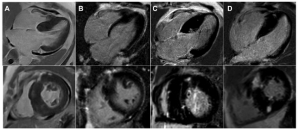 Radiology:肥厚性心肌病的心肌究竟是怎样纤维化的？从影像到病理的有一迈进！