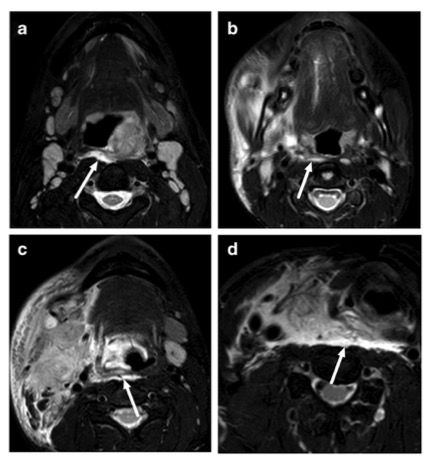 European Radiology：急诊MRI对颈部感染患者的临床和预后意义