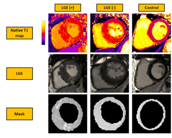 European Radiology：基于T1 mapping的自动机器学习在HCM心肌纤维化方面的应用