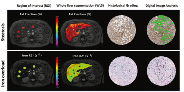 Radiology：用于定量MRI分析的全自动肝<font color="red">分割</font>