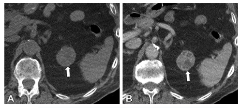 Radiology：兩版<font color="red">Bosniak</font><font color="red">分</font><font color="red">型</font>對腎囊性腫塊的評估究竟有何不同？