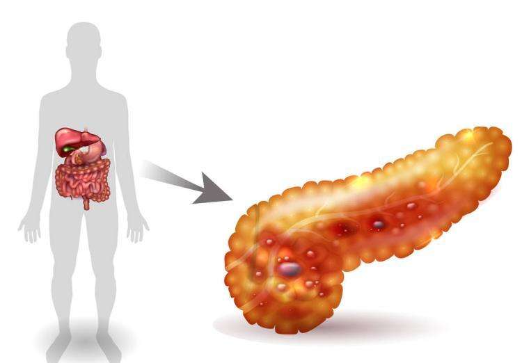 Pancreatology: 胰岛自体移植 (TPIAT) 全胰腺切除患者术后第一年骨密度会明显降低