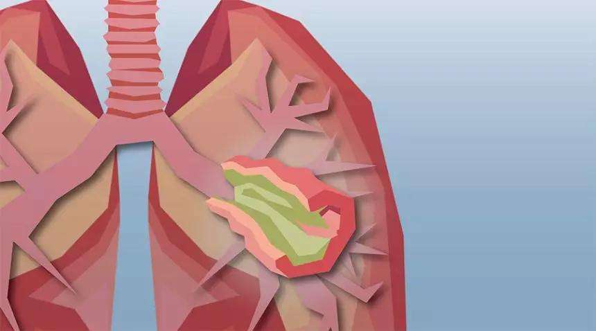 Dig Liver Dis：囊性纤维化患者中血清胆汁酸和甘醇脱氧胆酸水平可以作为肝脏病变的生物标志物