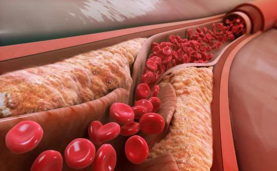 Dig Liver Dis：血清胆固醇水平可以预测接受经颈<font color="red">静脉</font>肝内门体分流术的肝硬化患者的无移植生存率