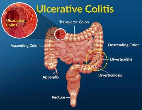 Dig Liver Dis：回肠储袋-肛门吻合术(IPAA)后发生慢性储袋炎和克罗恩病的危险因素分析
