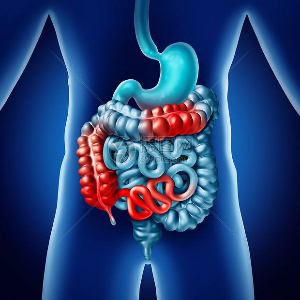 Clinical Gastroenterology H：生物制剂不会增加<font color="red">既往</font>有恶性肿瘤病史的炎症性肠病<font color="red">患者</font><font color="red">癌症</font>复发的风险