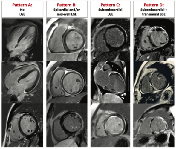 Radiology：心肌炎若出现这一心脏MRI表现，影像科医师一定要认识！