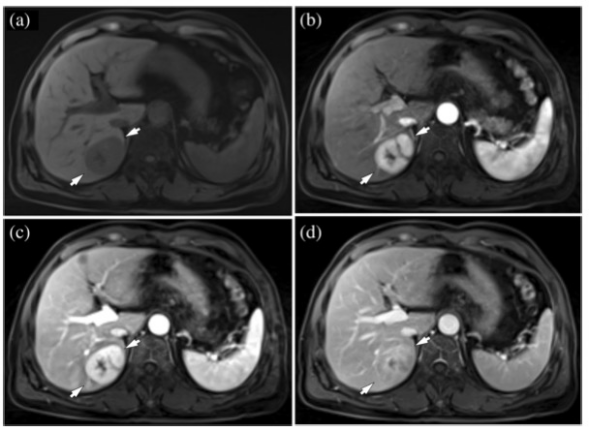 European Radiology：DCE-MRI可实现肝纤维化评估的“一步到位”！