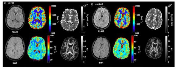 European Radiology：MR指纹技术在轻度创伤性脑损伤中的应用