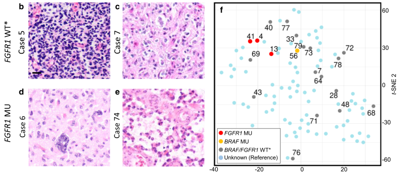 Acta Neuropathologica: 在一系列83例H3F3A K27M突变的弥漫性中线胶质瘤中，FGFR1突变与较好的预后相关 