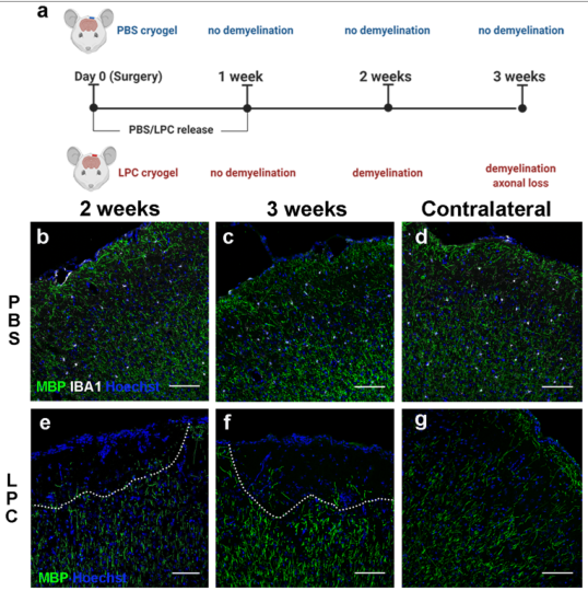 Acta Neuropathologica: MS选择性神经退行性变可能继发于皮质脱髓鞘