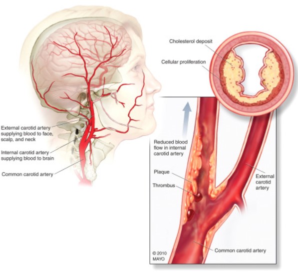 Stroke：症状性<font color="red">颈动脉</font>狭窄，<font color="red">颈动脉</font>内膜切除术仍然是早期治疗最安全的血管重建方法！
