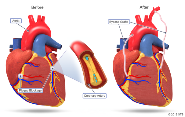 JAMA Cardiology：<font color="red">性别对</font>单根与多根移植动脉CABG术的长期影响