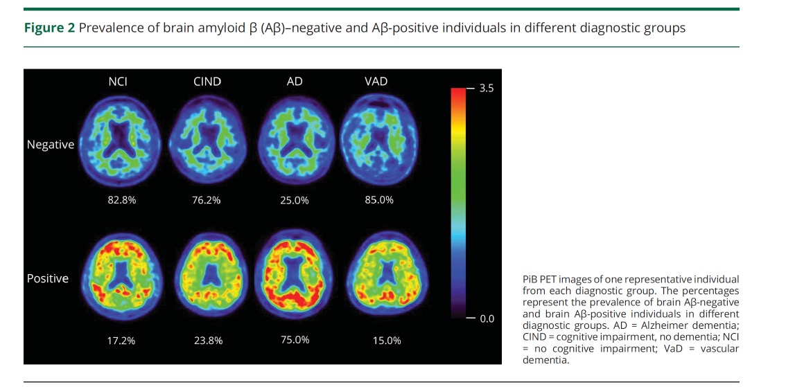 Neurology：Aβ和小血管疾病对认知障碍的影响具有<font color="red">协同</font><font color="red">作用</font>