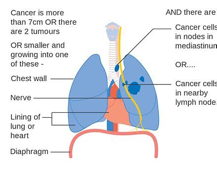 中国国家<font color="red">药品管理局</font>（NMPA）授予sotorasib治疗晚期非小细胞肺癌“突破性疗法称号”