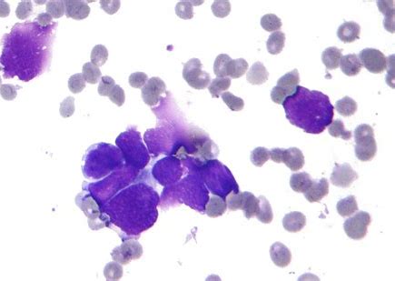 WCLC 2020：Tagrisso可显著延长EGFR突变非小细胞肺患者的<font color="red">无病</font><font color="red">生存期</font>