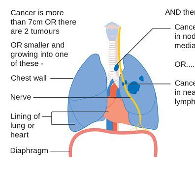 WCLC 2020：Datopotamab deruxtecan和Enhertu在晚期非小细胞肺癌患者中显示出有希望的临床<font color="red">活性</font>