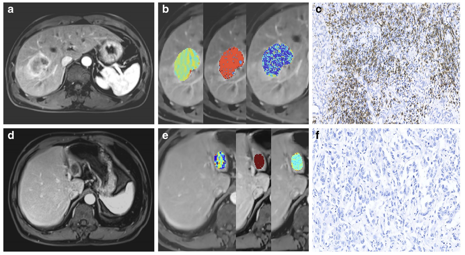 Eur Radiol：在MRI图像上人眼发现不了的肝内胆管细胞癌免疫表型，<font color="red">纹理</font><font color="red">分析</font>却能发现！
