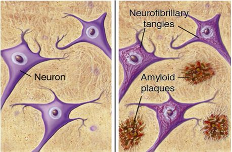 Stroke：Aβ和Tau在脑小<font color="red">血管</font>疾病和皮质微梗死之间的关系