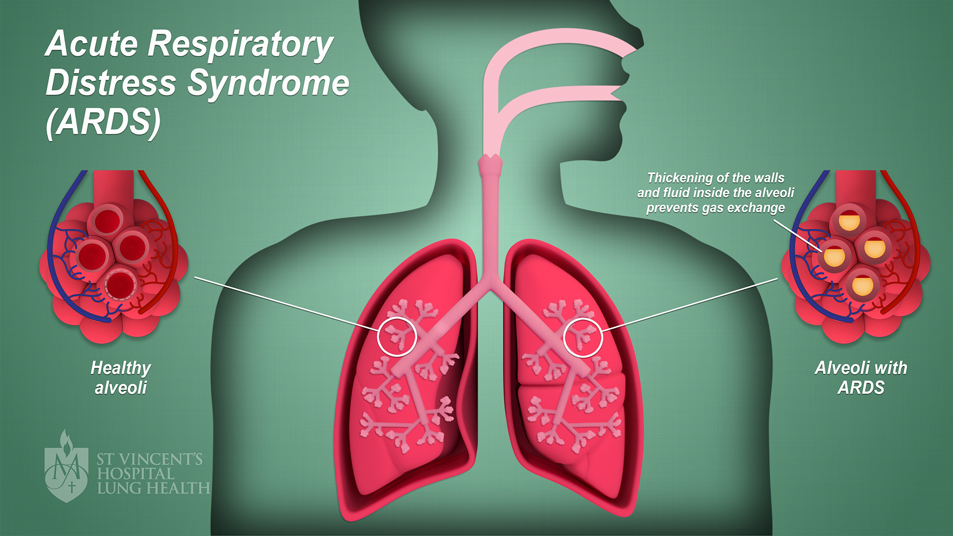 BMJ子刊：肺活检在急性呼吸窘迫综合征诊断中的安全性和可行性分析