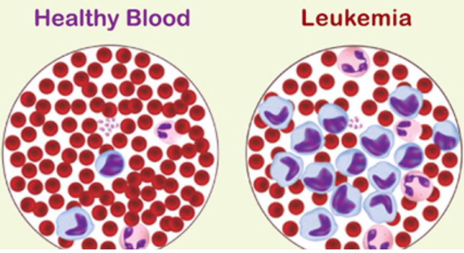 Blood：Flotetuzumab作为难治性<font color="red">AML</font>患者的补救免疫<font color="red">疗法</font>的疗效和安全性