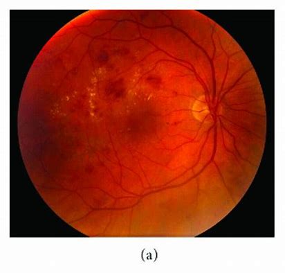 视力下降疗法<font color="red">Faricimab</font>将两次治疗之间的时间延长了四个月