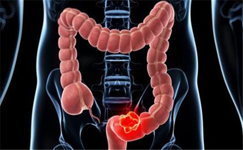 BMJ Gastroenterology:低剂量阿司匹林引发低<font color="red">胃肠</font>道<font color="red">出血</font>并降低结直肠肿瘤的风险