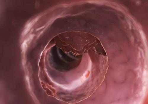 BMJ Gastroenterology：大肠癌的危险因素因解剖部位不同而异