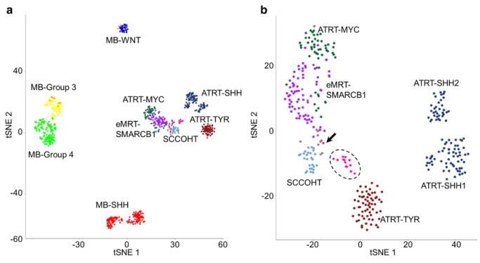 Acta Neuropathologica: 具有SMARCA4突变的非典型畸胎样/<font color="red">横纹肌</font>样肿瘤在分子水平上不同于SMARCB1缺陷病例