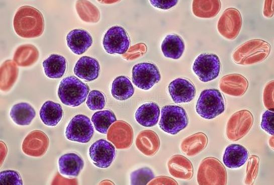 Cancer Discov：Venetoclax+Navitoclax+化疗治疗复发/难治性<font color="red">急性</font>淋巴细胞<font color="red">白血病</font>和淋巴母细胞淋巴瘤