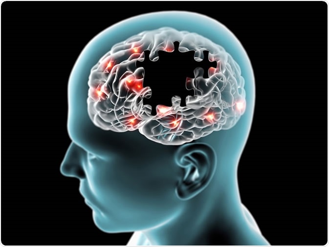 Alzheimers Dementia：美国6000万人数据研究发现，痴呆患者的新冠风险大大增加