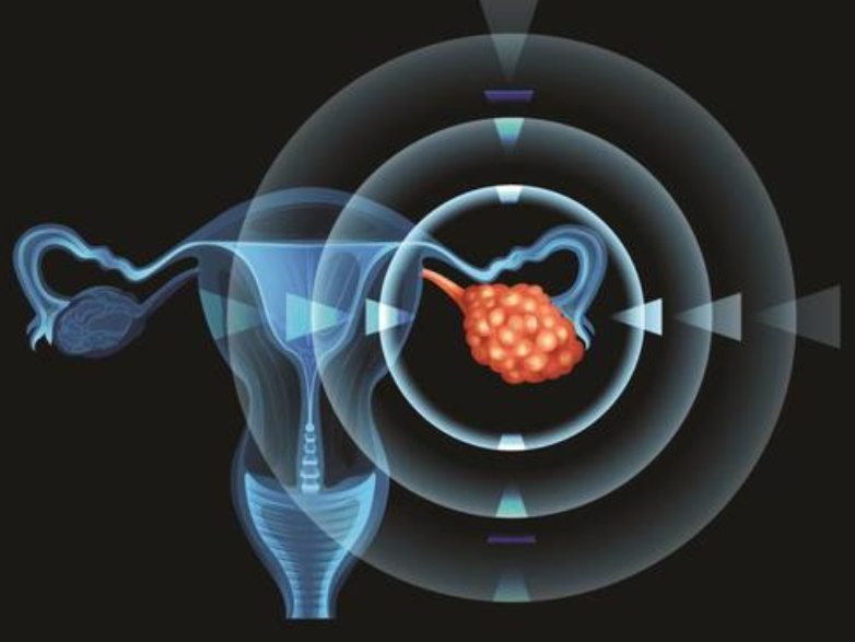 ESMO Open：西地尼布联合化疗治疗复发性卵巢癌的3期试验结果