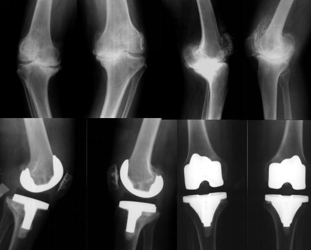 JAMA Netw Open：纳入多因素的AI辅助决策工具有助于为晚期膝骨关节炎患者制定更好的治疗方案